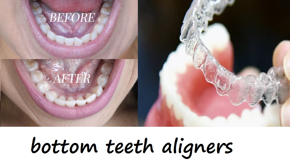 bottom teeth aligners