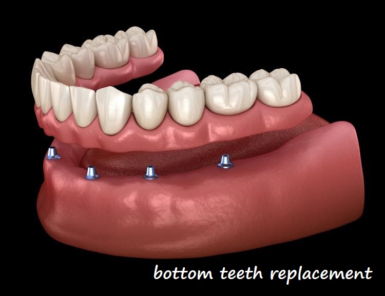 bottom teeth replacement