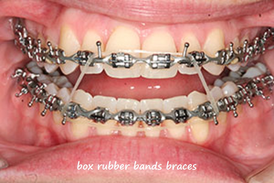 box rubber bands braces