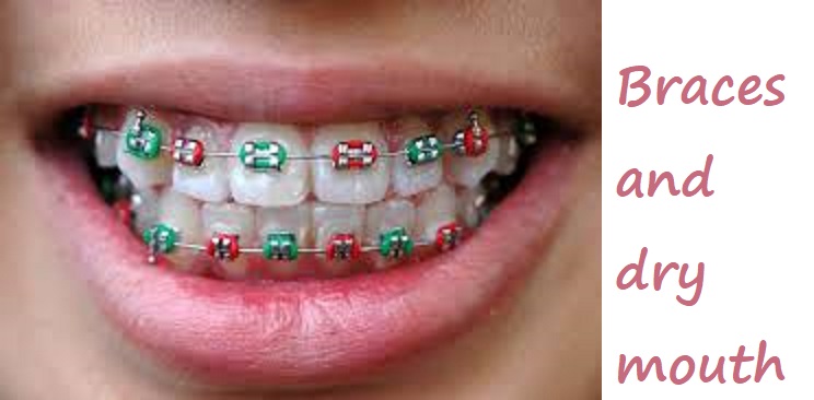 braces and dry mouth