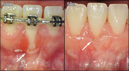 Braces bone loss