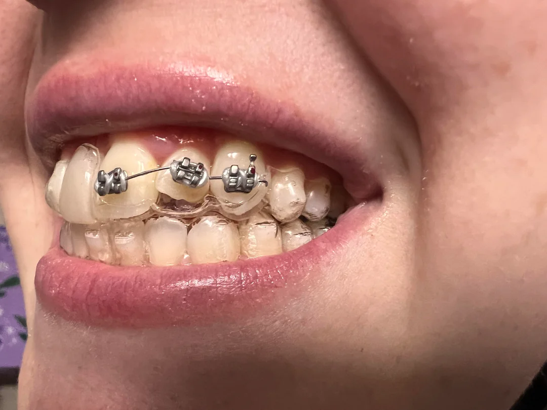 braces for one tooth