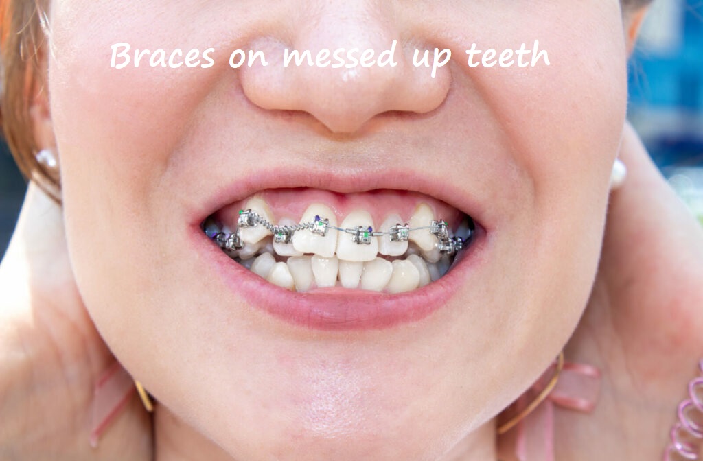 braces on messed up teeth