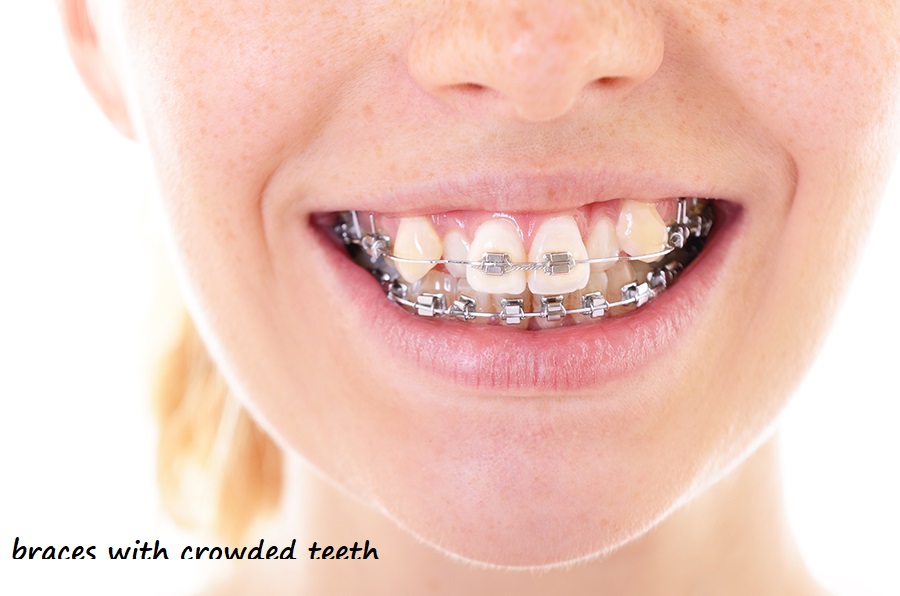 braces with crowded teeth