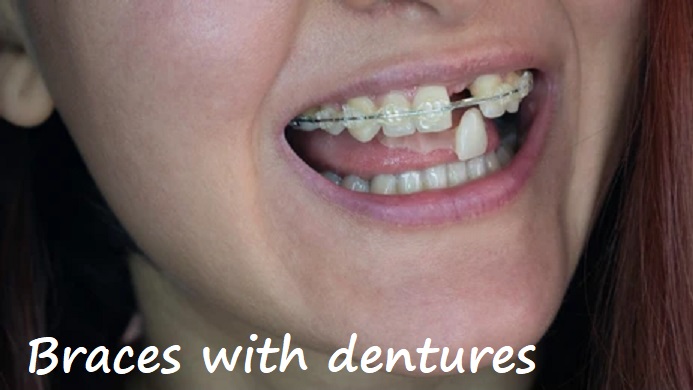 braces with dentures