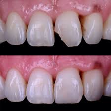 Front tooth crown for broken tooth. Before and after crown placement images.