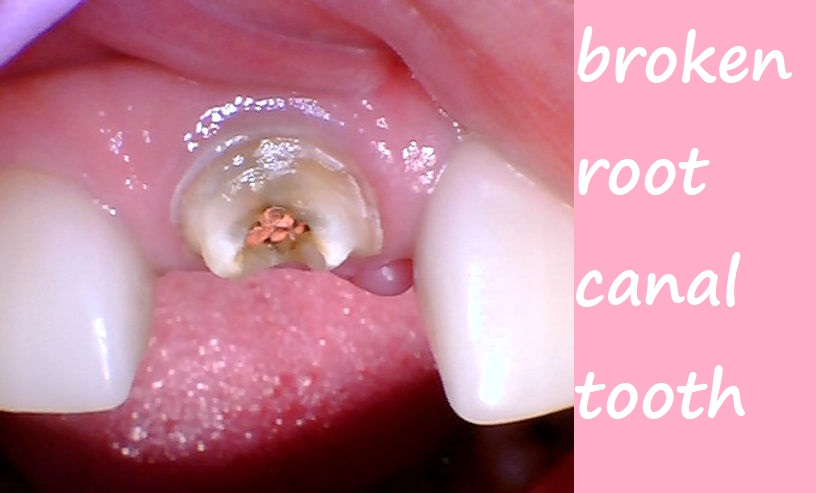 broken root canal tooth