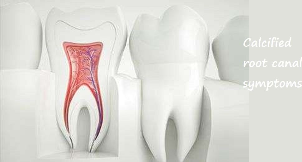 calcified root canal symptoms