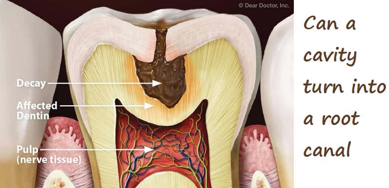 can a cavity turn into a root canal