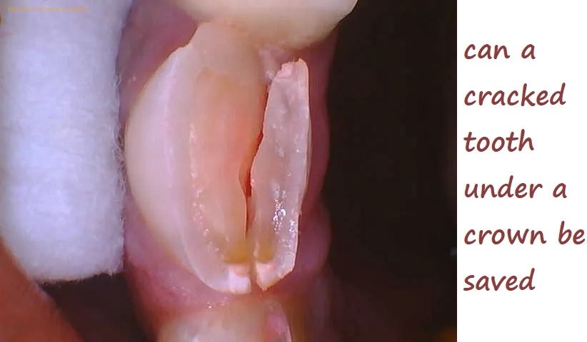 can a cracked tooth under a crown be saved