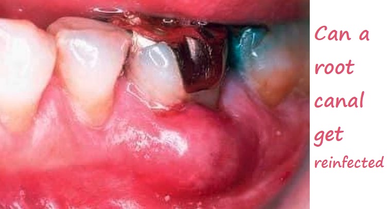 can a root canal get reinfected