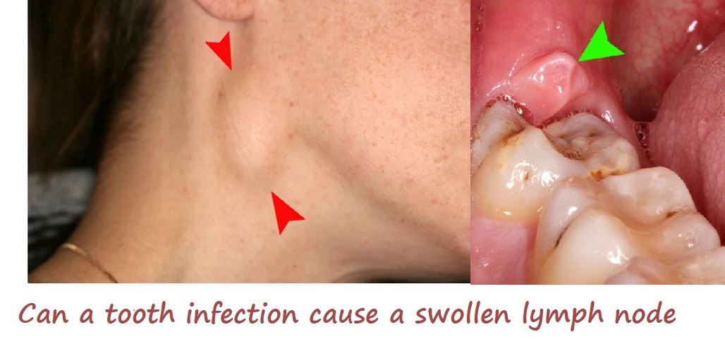 can a tooth infection cause a swollen lymph node