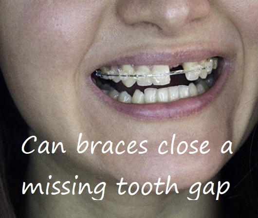 Can braces close a missing tooth gap