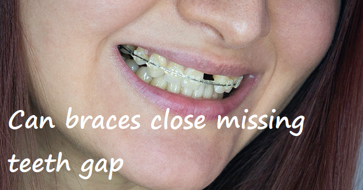 can braces close missing teeth gap