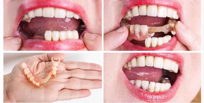 can dentures be fitted to receding gums