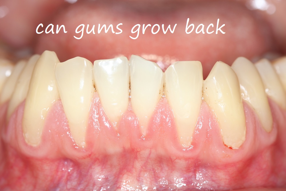 can gums grow back