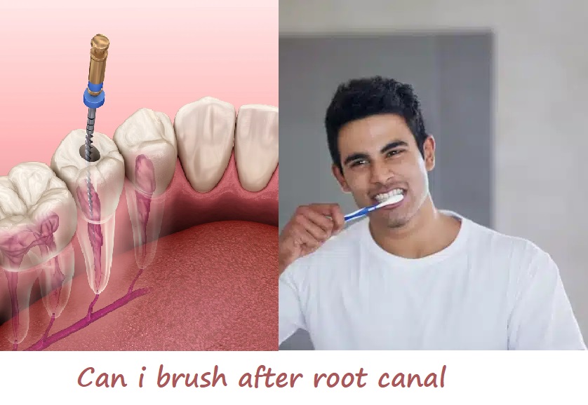 can i brush after root canal