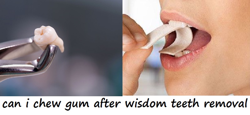 can i chew gum after wisdom teeth removal