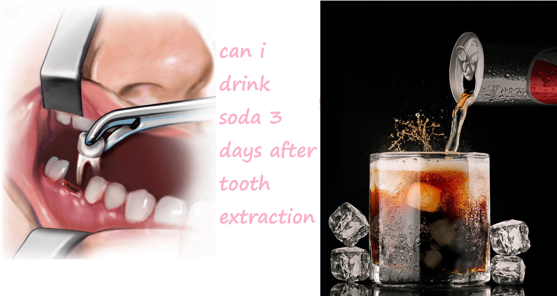 can i drink soda 3 days after tooth extraction