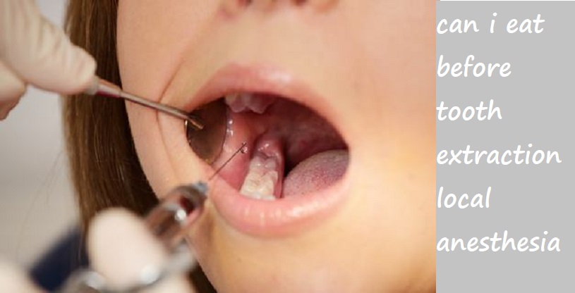 can i eat before tooth extraction local anesthesia