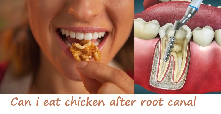 can i eat chicken after root canal