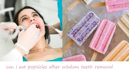 can i eat popsicles after wisdom teeth removal