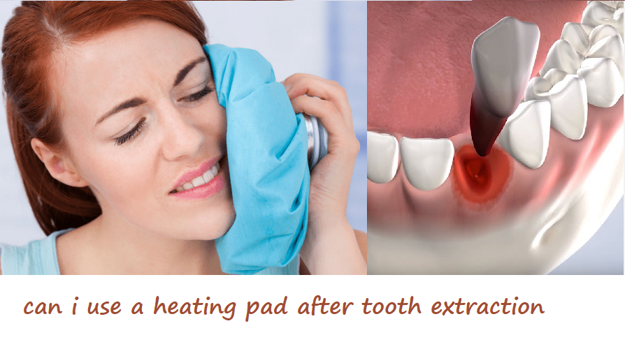 can i use a heating pad after tooth extraction