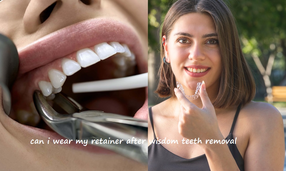 can i wear my retainer after wisdom teeth removal