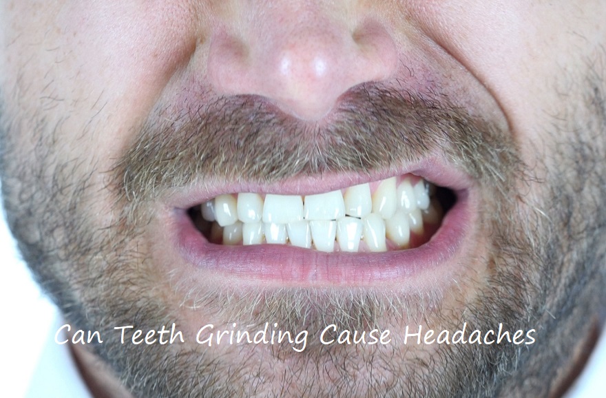 Can Teeth Grinding Cause Headaches