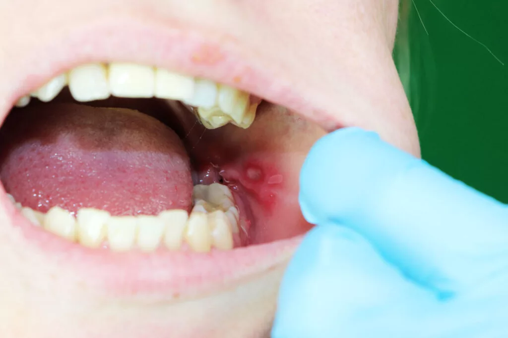 can wisdom teeth cause canker sores