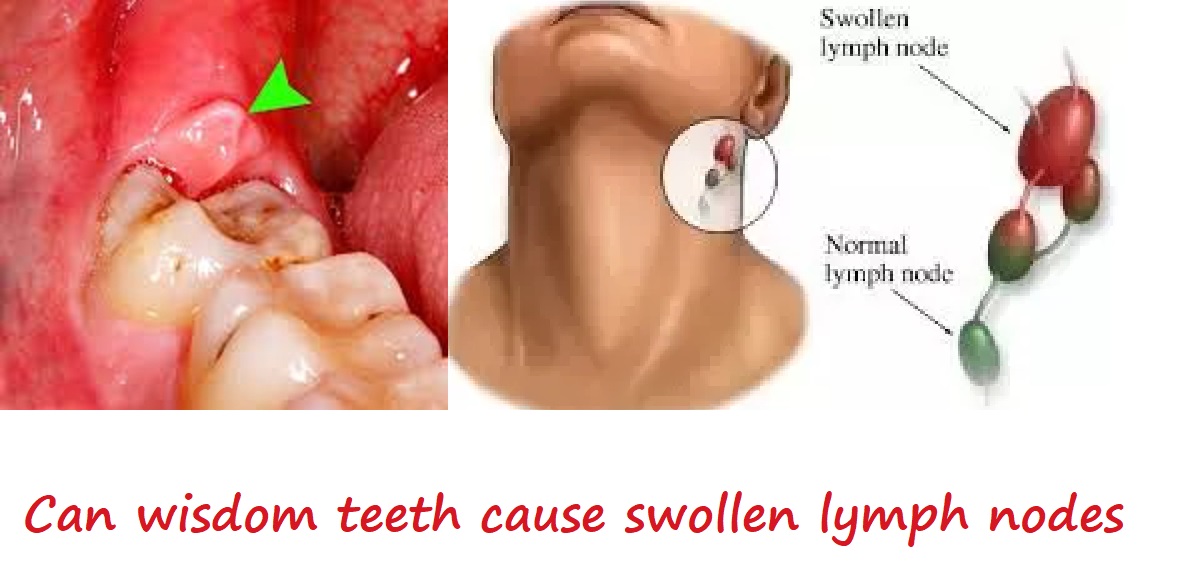 can wisdom teeth cause swollen lymph nodes