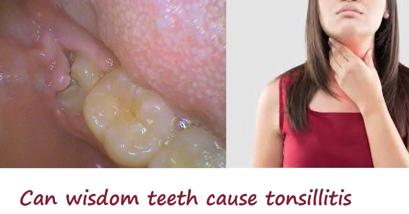 can wisdom teeth cause tonsillitis