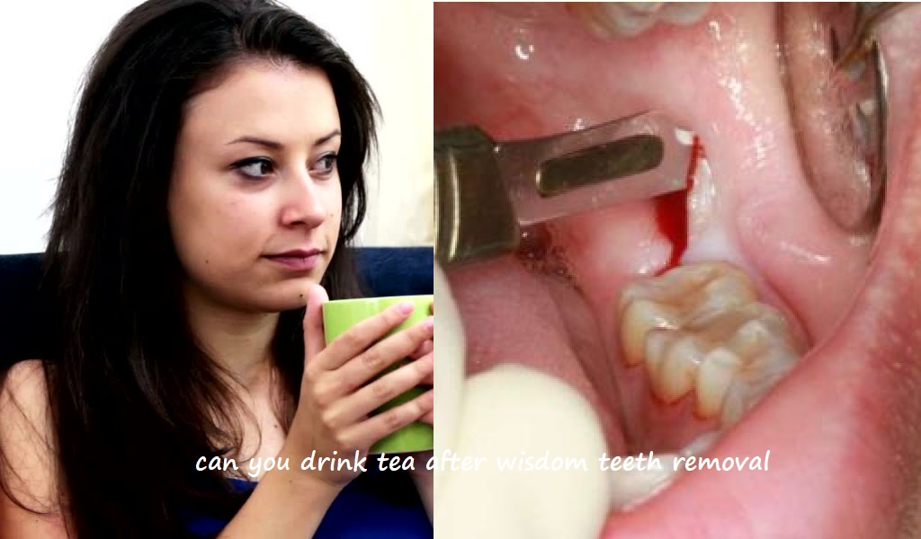 can you drink tea after wisdom teeth removal