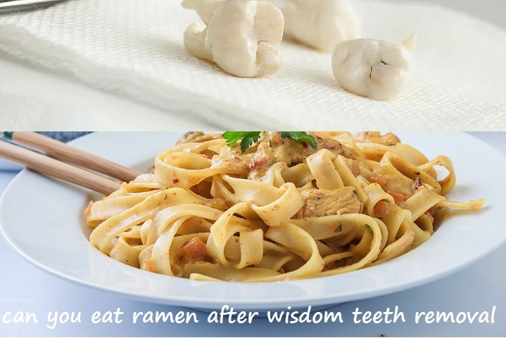 can you eat ramen after wisdom teeth removal