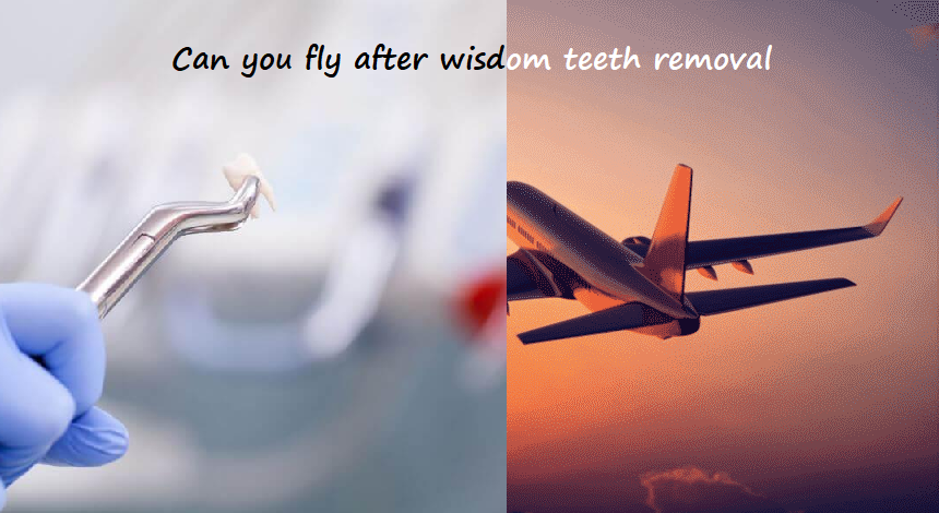 can you fly after wisdom teeth removal