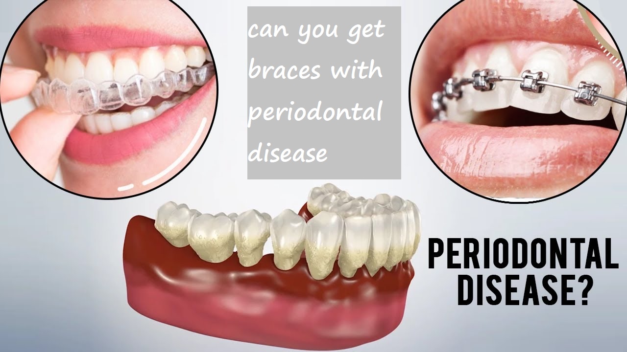 can you get braces with periodontal disease