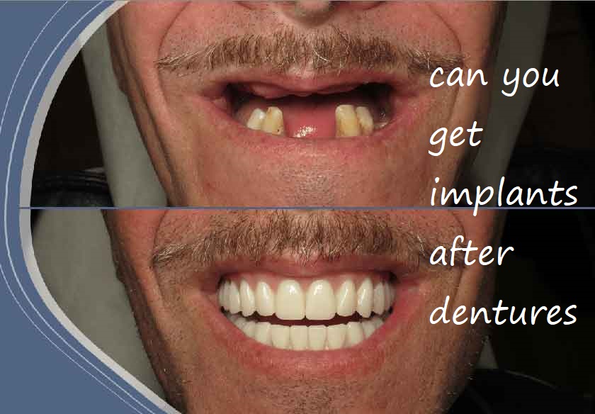 can you get implants after dentures