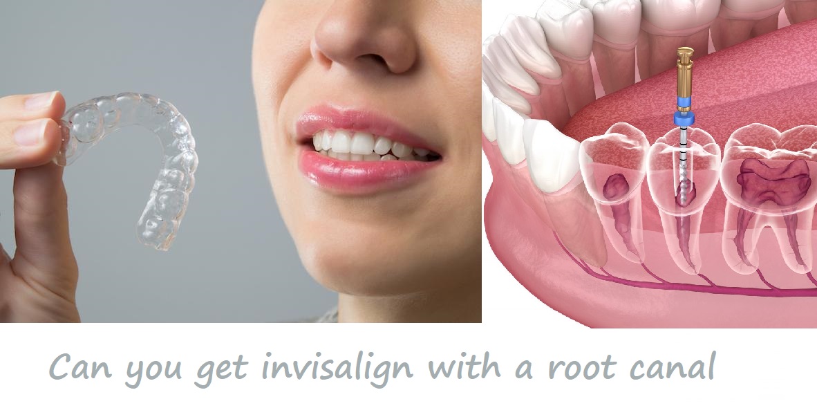 can you get invisalign with a root canal