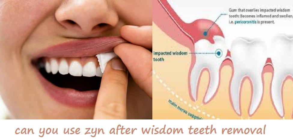 can you use zyn after wisdom teeth removal