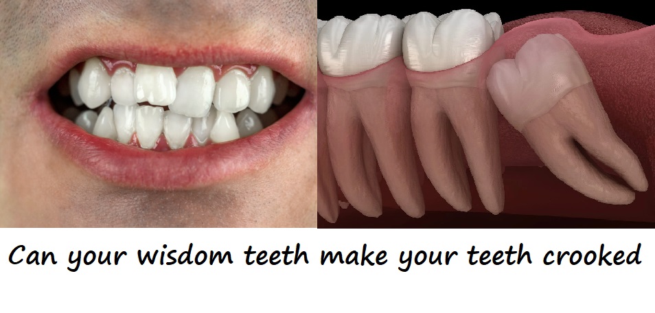 can your wisdom teeth make your teeth crooked