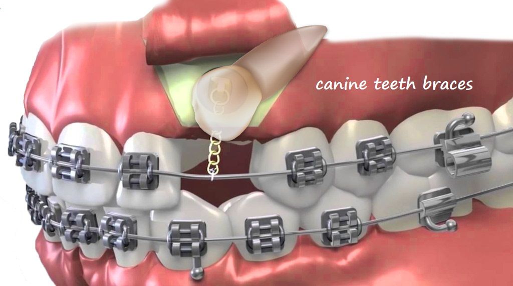 canine teeth braces