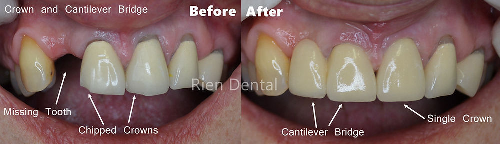 cantilever bridge teeth