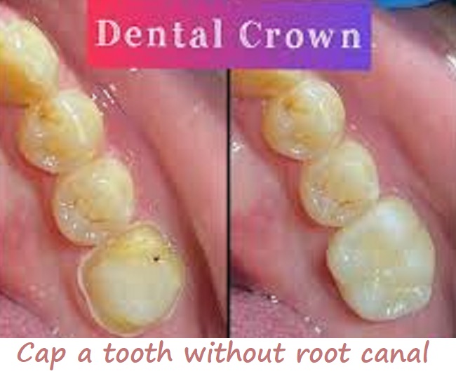 cap a tooth without root canal