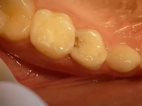 cavities between teeth