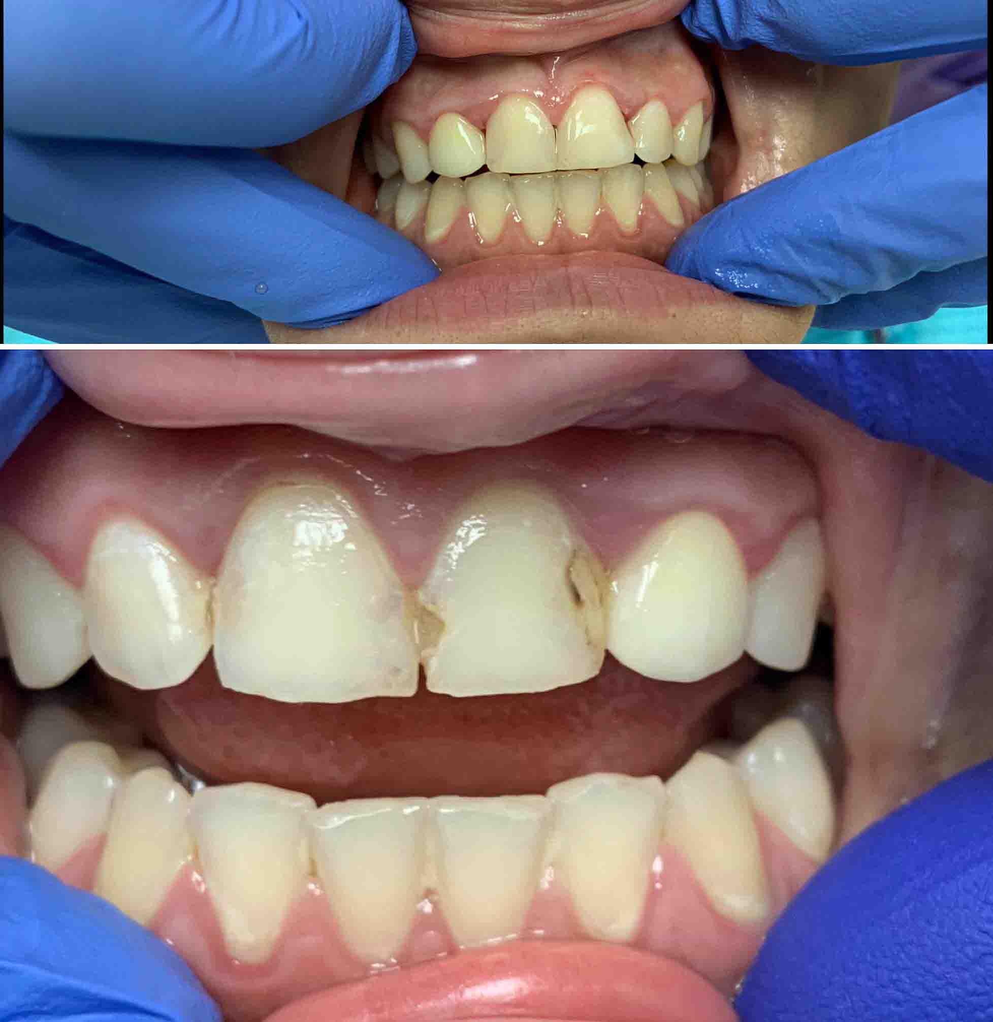 cavity in front tooth