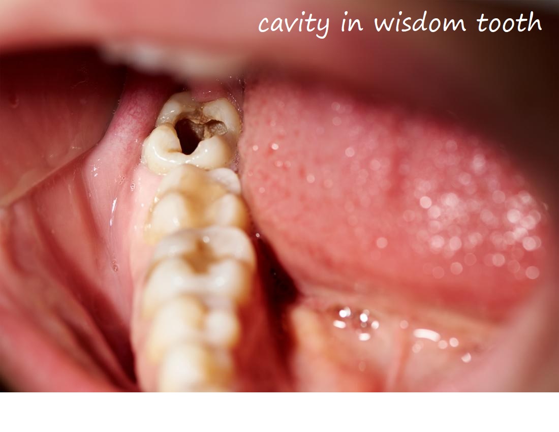 cavity in wisdom tooth