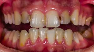 cavity on front tooth