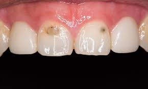 cavity on front tooth