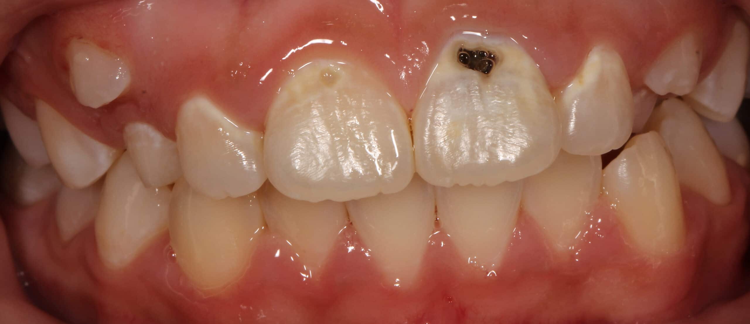 cavity on front tooth