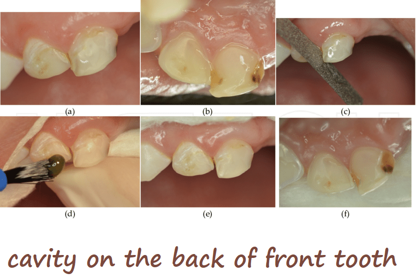 cavity on the back of front tooth